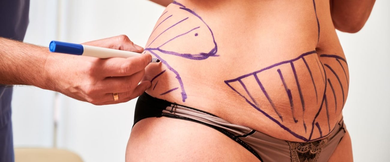 Mejores doctores de lipolaser en Bogotá, Colombia: top recomendados por expertos