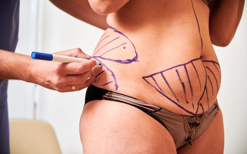 Mejores doctores de lipolaser en Bogotá, Colombia: top recomendados por expertos